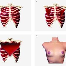 Irritation, inflammation, back rib injury, strained or pulled back muscles, or a herniated disc can all cause pain in ribs and back. Mamo Simulator Components A Complete Rib Cage Intercostal Muscles Download Scientific Diagram