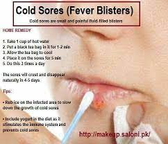 Cold Sore Tips Cold Sores Remedies Cold Sore Treatment Cold Sore