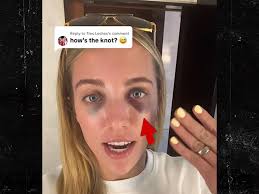 WNBA's Lexie Hull Shows Off Black Eyes After Game Collision