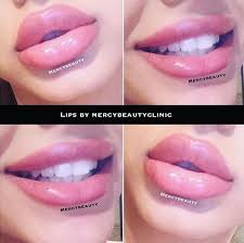 Tips To Make The Most Out Of Your Skin Botox Lips Lip Fillers Juvederm Lip Injections Juvederm