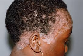 Scalp psoriasis can affect the scalp, hairline, forehead, back of the neck and skin around the ears. Scalp Psoriasis And Natural Hair Natural Sisters South African Hair Blog