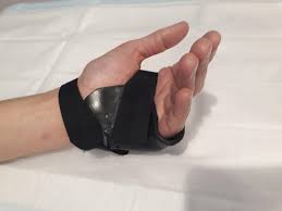 Image result for Ulnar Gutter Cast