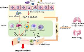 Image result for Allergic Triad