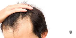 Spironolactone (aldactone) is prescribed for people who have thinning hair related to androgen production. What You Can Do About Men S Thinning Hair Ahs India