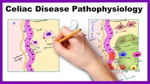 A type of 3 indicates symptomatic celiac. Celiac Disease Pathophysiology Simplified Youtube