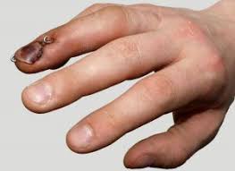 • closed injury with or without small dorsal avulusion fracture. Mallet Finger In Mesa Chandler Gilbert Tempe And Phoenix Gerald L Yospur M D