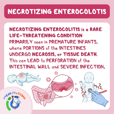 Image result for Necrotizing Enterocolitis