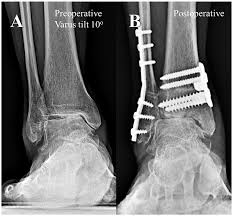 Image result for Talar Tilt