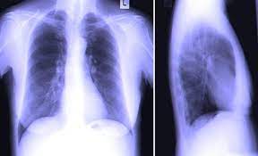 Pneumonia is the infection and inflammation of air sacs in your lungs. Klinisk Diagnose Av Pneumoni Nhi No