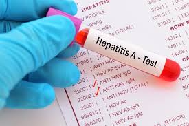 Sakit perut urine gelap demam nyeri sendi kehilangan nafsu makan mual dan muntah terkadang keluhan berlanjut menjadi tubuh bertambah kuning (kuning gelap) yang merupakan tanda adanya sumbatan pada saluran kandung. Hepatitis A Lifepack Id