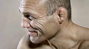 Fighters being fighters, however, often times wear it proudly like a badge of honor! Top 7 Worst Cauliflower Ears In Mma History Mma Insight