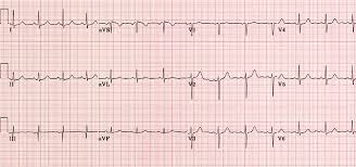 Ecg Ekg Examples And Quiz Oxford Medical Education