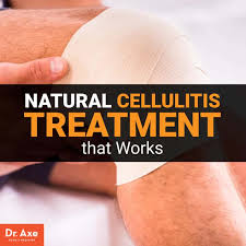 Within three days of starting an antibiotic, let your doctor know whether the infection is responding to treatment. Cellulitis Treatment Natural Remedies Prevention Tips Dr Axe