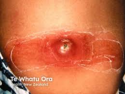 Image result for Skin Abscess