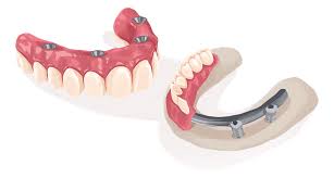 Free initial consultation for dental implants. Dental Implants London Missing Teeth Implant Replacement