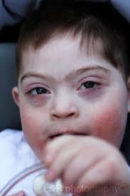 My nephew Easton was born with EB. He was in the hospital almost his whole  first year of life, came close to losing him a few times. He's 12 now, and  doing