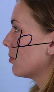 Midface Volumization with Injectable Fillers