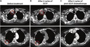 Typically, patients with pleural mesothelioma receive a ct of the chest with contrast dye. Tumor Regression In A Pleural Mesothelioma Patient Treated With Download Scientific Diagram