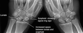 Image result for Scapholunate Dislocation