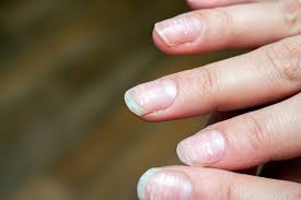 Weisse Flecken Auf Fingernagel Woher Kommen Sie Und Was Hilft