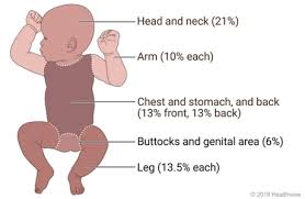 Rule Of Nines For Burns In Babies And Young Children