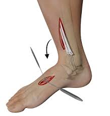 Each foot is made up of 26 bones, 30 joints and more than 100 muscles, tendons and ligaments, all of which work together to provide support, balance and mobility. Tendon Transfer Surgery Milwaukee Flexible Flatfoot Brookfield