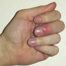 If you are female, paint your nails. Paronychia Wikipedia