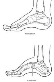 Your low arches may contribute to muscle stress and joint problems. Cavus Foot High Arched Foot Foot Health Facts