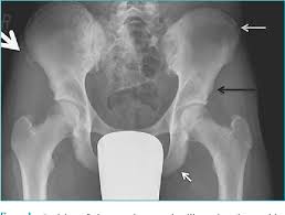 Image result for Hip Apophysitis