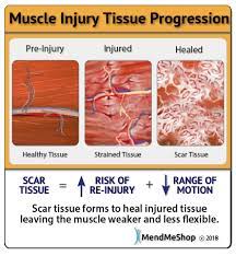 Muscle Strain Information And Treatments