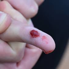 Image result for Pyogenic Granuloma