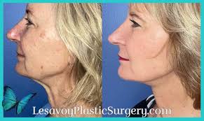 Gen X Facial Rejuvenation