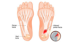 Tips Meredakan Nyeri Tumit Plantar Fasciitis