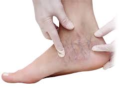 Varicose Veins In Feet And Ankles Symptoms And Treatment Vein Health