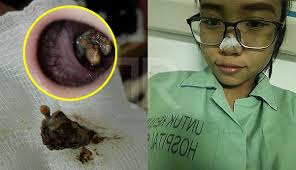 Epistaxis) atau mimisan adalah satu keadaan pendarahan dari hidung yang keluar melalui lubang hidung. Satu Rumah Bau Bangkai Rupanya Berpunca Dari Batu Resdung Dalam Hidung The Reporter