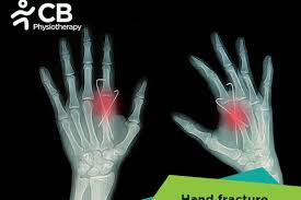 Image result for Hand Fracture