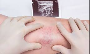 Trombosis venosa cerebral  definición la trombosis venosa cerebral es una condición arauz. Que Es La Trombosis Venosa Profunda Revista Salud Y Cardiologia
