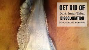 Skin Bleaching How To Get Rid Of Dark Inner Thighs Naturally Skin Li Skin Bleaching Lighten Inner Thighs Lighten Skin Fast