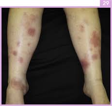 Image result for erythema nodosum