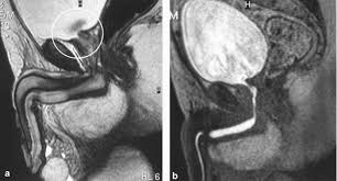 Image result for Voiding Cystourethrogram