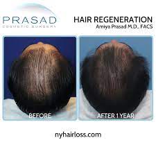 Find more hair loss centers near advanced hair center. Why Acell Prp Treatments Are Not All The Same Hair Regeneration