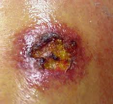 Image result for wolf spider bite skin