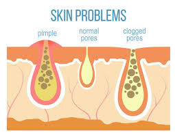Kembalikan seri kulit badan anda dengan 10 krim hapus parut. Jenis Dan Cara Hilangkan Parut Jerawat Messarah