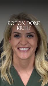 Refreshed, not frozen. Effortless movement with softened lines, the art of  subtle Botox/Dysport. , #scottsdaleinjector #botoxcosmetic  #restylanekysse💋 #scottsdalemedspa