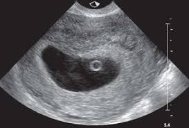 Image result for First Trimester Ultrasound