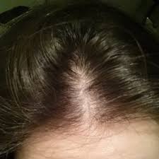 Clonazepam official prescribing information for healthcare professionals. Does Overall Health And Medications Affect Prp Or Other Hair Loss Treatment Results Photo