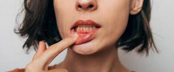 Image result for gums cancer symptoms