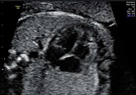 Ecografia Obstetrica 1º Trimestre 2º Trimestre Morfologica 3º T