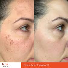 A treatment for severe nodular acne: Beautify Skin With Ipl Treatment Garza Plastic Surgery