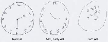 Developmentof scoring criteria for the clock drawing task in alzheimers disease. Montreal Cognitive Assessment Wikiwand